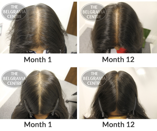 Female-Pattern-Hair-Loss-Client-Thinning-Hair-Restored-with-Belgravia-Centre-Treatment